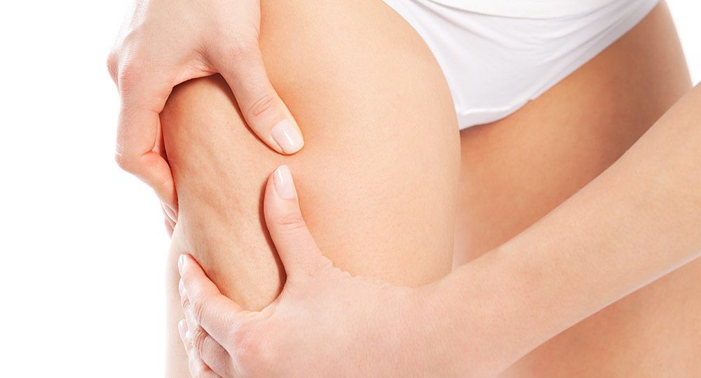Cellulite, non e’ un aumento di grasso!